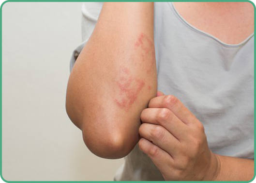 Có thể sử dụng cho da các trường hợp rạn da, phát ban và da bị tổn thương sau tăng hoặc giảm cân đột ngột.